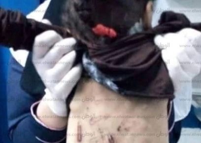 أثار التعذيب على جسد الطفلة جنة محمد