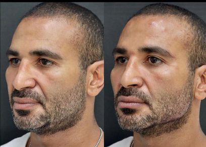 أحمد سعد قبل وبعد عملية التجميل