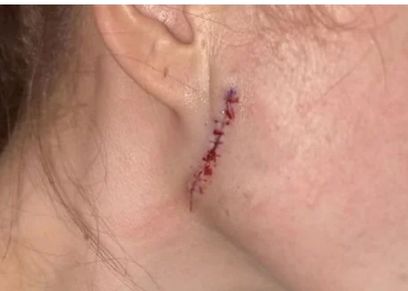 فتاة تتعرض لحرق وتشوه وجهها