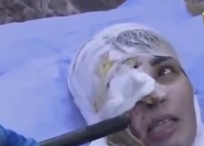 السيدة العراقية بعد تشوه وجهها