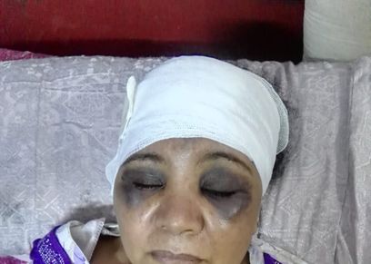 فاطمة بعد الاعتداء عليها من شقيق زوجها