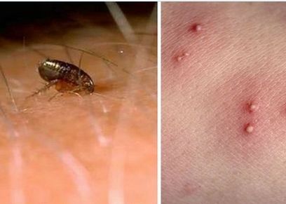 طرق طبيعية تساعدكِ على تخفيف لدغات الحشرات