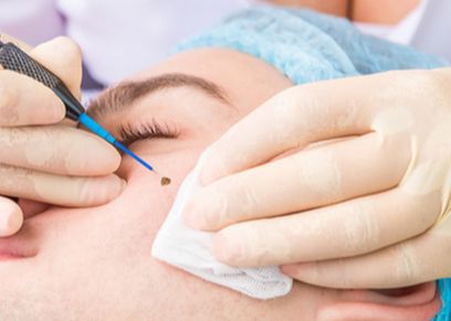 حكم عملية التجميل لإخفاء الحسنة