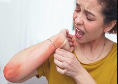 أبرز أعراض حمى الضنك