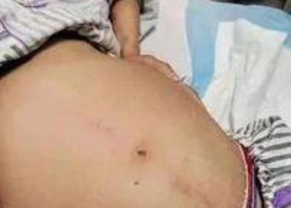 ما هو داء هيرشسبُرونغ سيدة صينية أُصيبت به.. ما القصة؟