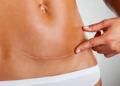 طرق إخفاء علامة الولادة القيصرية