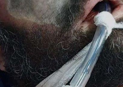أعراض مرض الفطر الأسود في العين