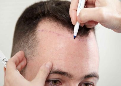 عملية زرع الشعر عند الرجال