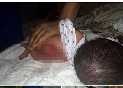 رضيع يعاني من ماء على المخ 