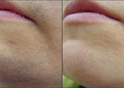 نصائح لإزالة شعر الوجه