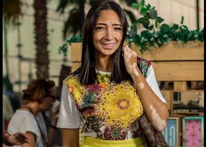 «من التعرض للتنمر للتوعية بخطورته».. لوجينا صلاح «سفيرة البهاق»