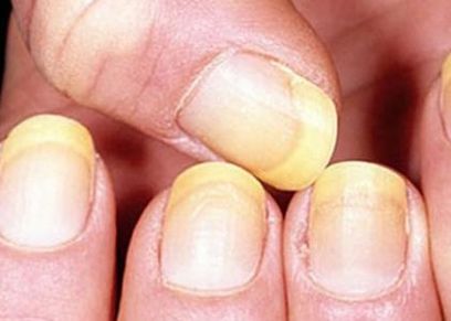 اصفرار الأظافر