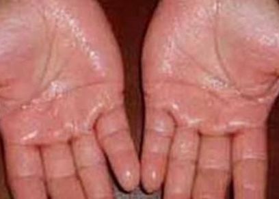 طُرق لعلاج تعرق اليدين