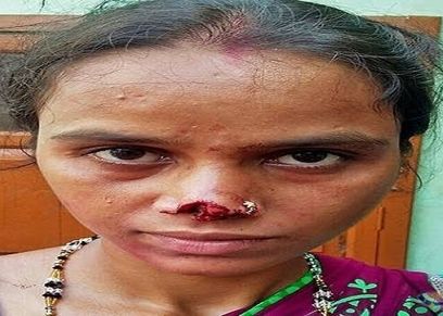 صورة أرشيفية لسيدة زوجها قطع أنفها