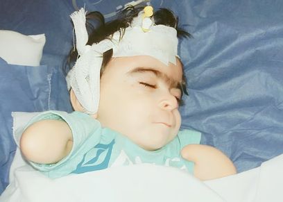 متلازمة نادرة تصيب طفل 3 سنوات