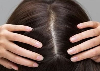 أمراض فروة الرأس في الشتاء- تعبيرية