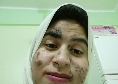 «جهاد» الفتاة المصابة