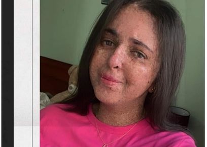 مرض نادر يعرض«فاطمة الزهراء»للتنمر