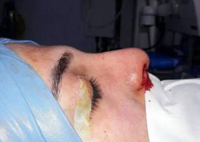 صورة أرشيفية لفتاة داخل احدى عمليات التجميل