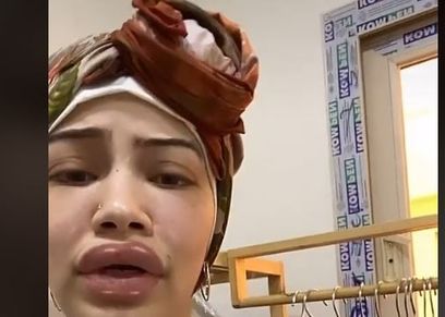 نادين ضحية فيلر الشفايف