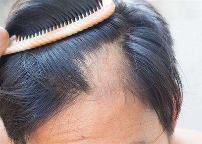 طرق علاج مرض الثعلبة