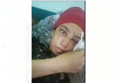 «فاطمة» فقدت عينيها بسبب خرطوش في خناقة