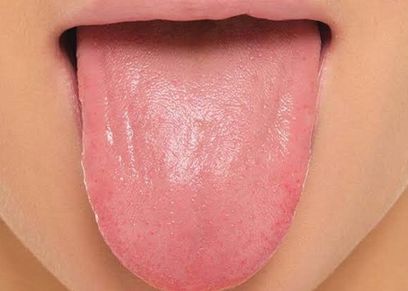 أعراض وعلاج سرطان اللسان