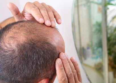 طريقة جديدة لمكافحة الصلع عند الرجال