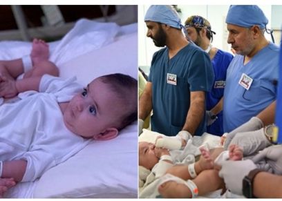 عملية فصل التوأم السيامي