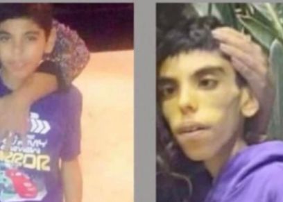 مصطفى قبل إجراء عملية زراعة الجهاز الهضمي