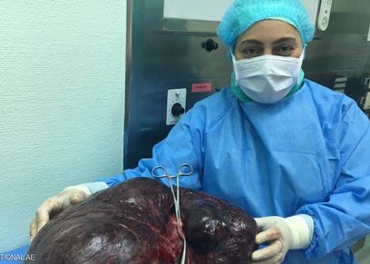 العملية استغرقت 3 ساعات تم خلالها إزالة رحم ومبيضي المريضة
