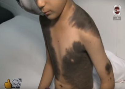 الطفل المشعر