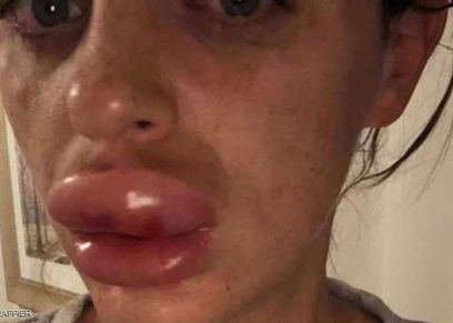 عمليات تجميل فاشلة