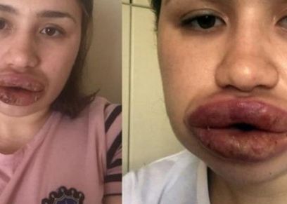 طبيب مزيف يشوه شفاه فتاة