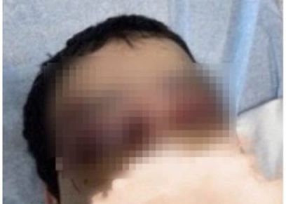 معنفة جدة بعد اعتداء زوجها عليها