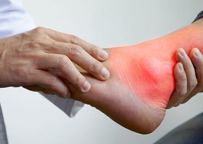 علاج النقرس بالأعشاب