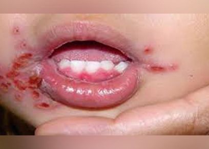 الهربس عند الأطفال
