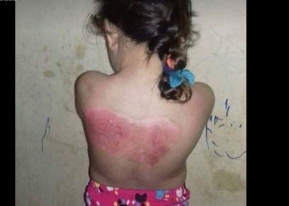 طفلة 5 سنوات تصاب بحروق في مناطق متفرقة من الجسم وتحتاج إلى المساعدة لعلاجها