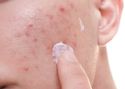 طرق علاج حب الشباب