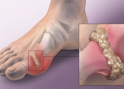 قدم مصابة بالنقرس