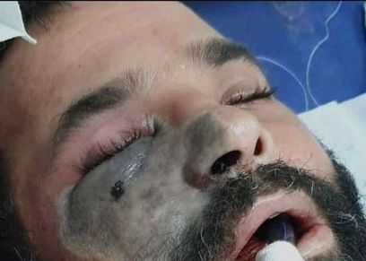 شخص مصاب بالفطر الأسود