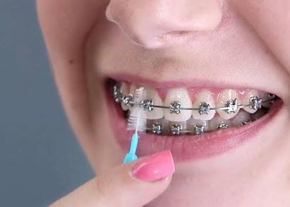 أستاذ تجميل أسنان ناصحا يجب الحفاظ على نظافة الاسنان أثناء التقويم