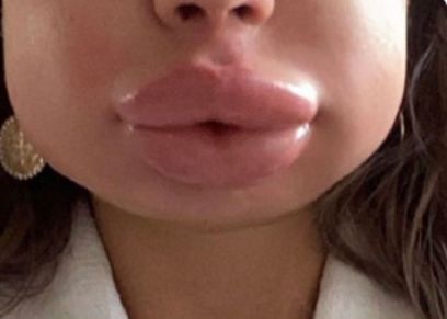 عملية تجميل غير ناجحة- صورة تعبيرية