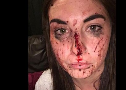 للحصول على تعويض مادي من حبيبها..فتاة تزيف اصابات في وجهها