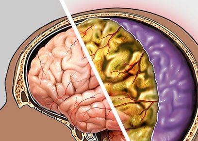 أعراض الالتهاب السحائي وعلاجه