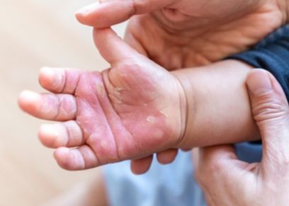 علاج الحروق عند الأطفال في المنزل