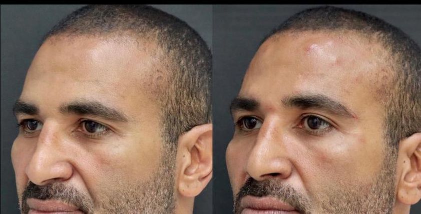 أحمد سعد قبل وبعد عملية التجميل