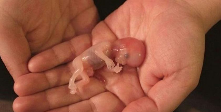أسباب حدوث الإجهاض المتكرر