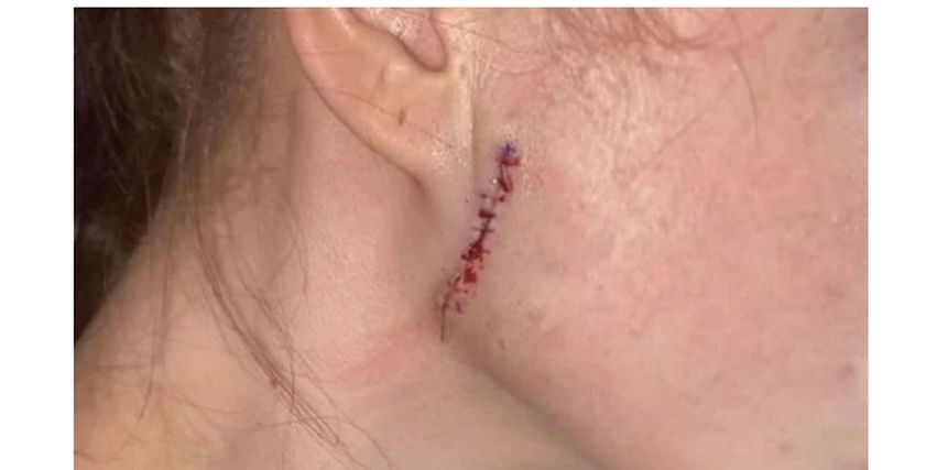فتاة تتعرض لحرق وتشوه وجهها