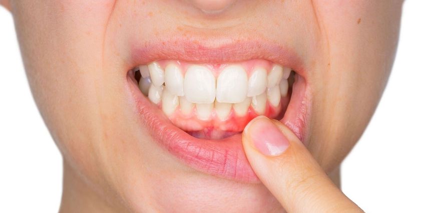 7 نصائح لتجنب أمراض اللثة 